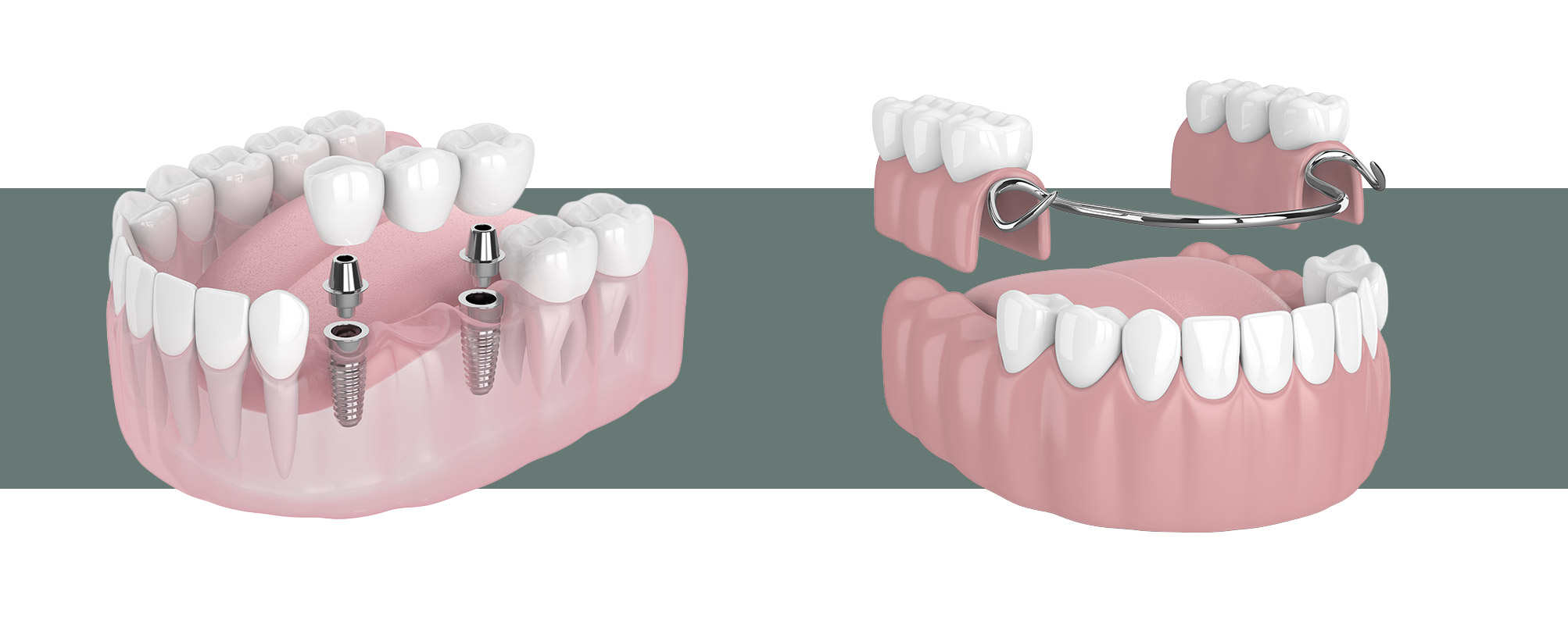Eine Darstellung von festem und herausnehmbaren Zahnersatz in der Zahnarztpraxis Dr. Röder DInlaken